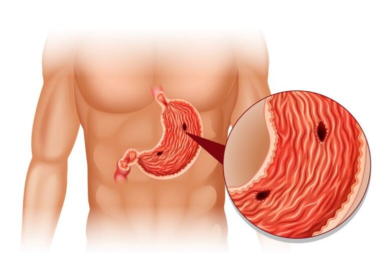 ulcer as the cause of pain under left scapula behind