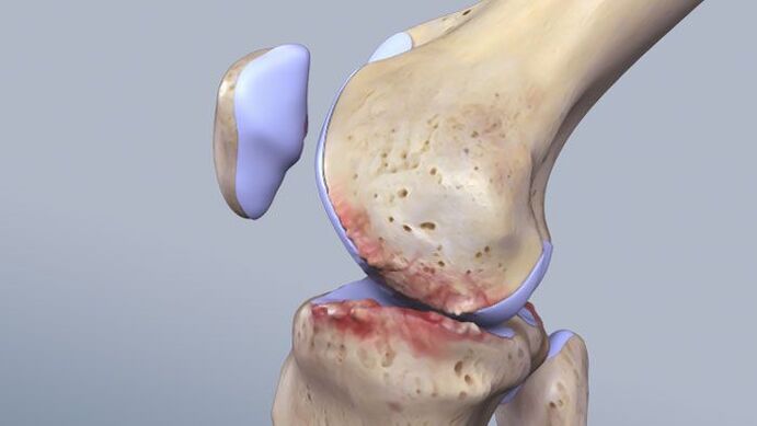 The structure of the knee joint affected by pathology