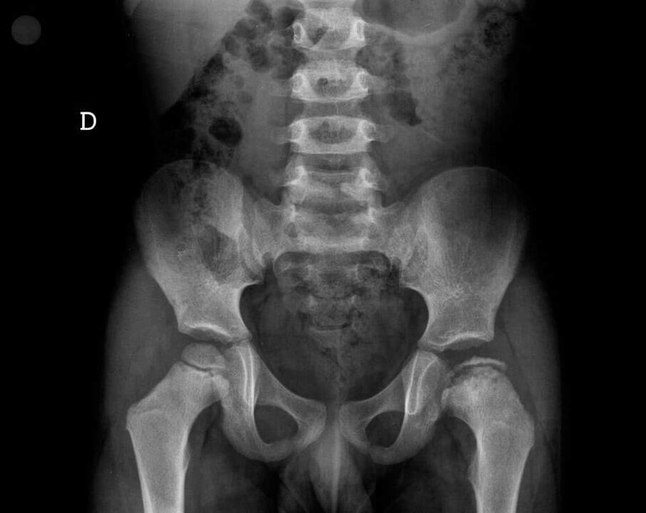 Legg-Calvé-Perthes disease – necrosis of the cartilaginous tissue of the femoral head