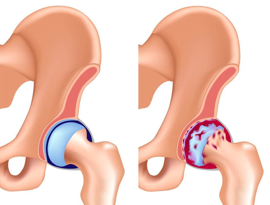 The most common cause of pain in the hip joint is coxarthrosis. 