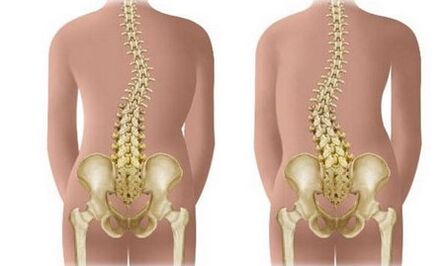 Not resistant scoliosis