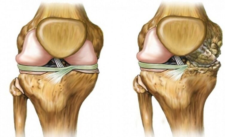 Healthy and affected by the articulation of arthrosis
