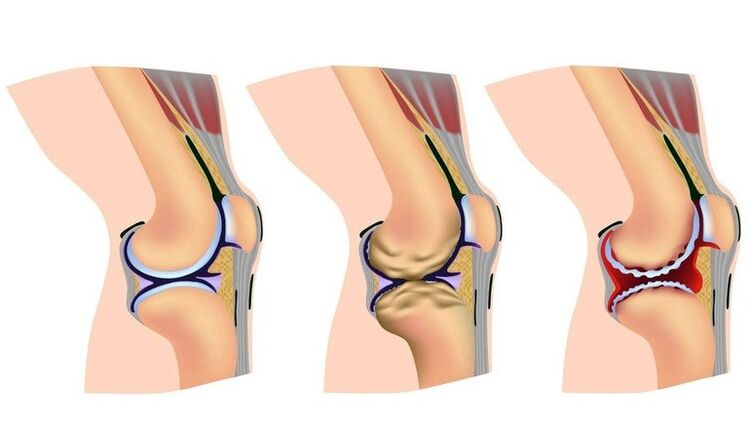 Knee joint deformation stages for arthrosis