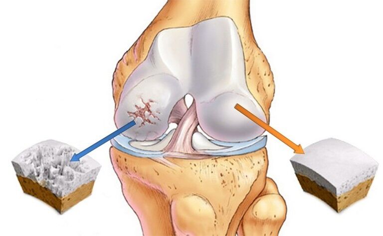 Normal cartilage and affected by arthrosis