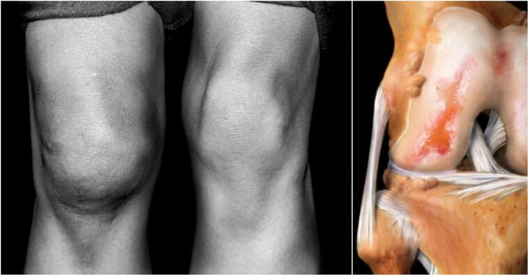 knee articulation arthrosis and painful articulation