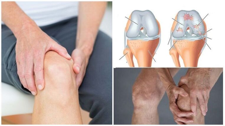 knee pain pain symptom of knee joint arthrosis