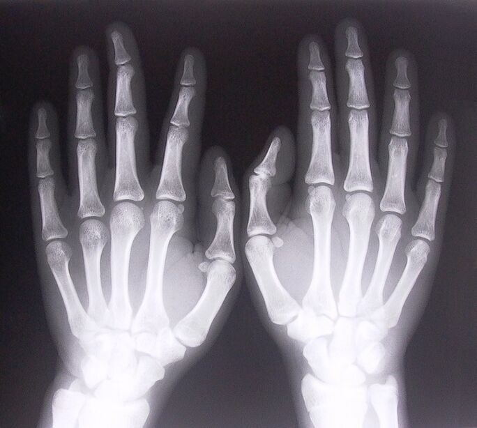 X-ray as a way to diagnose finger joint pain